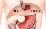 Rescue from a hiatal hernia What is a 2nd degree hiatal hernia?