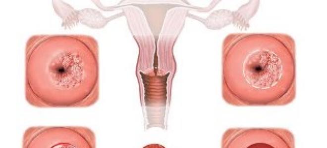 자궁 침식 연고 : 적응증 및 금기 사항